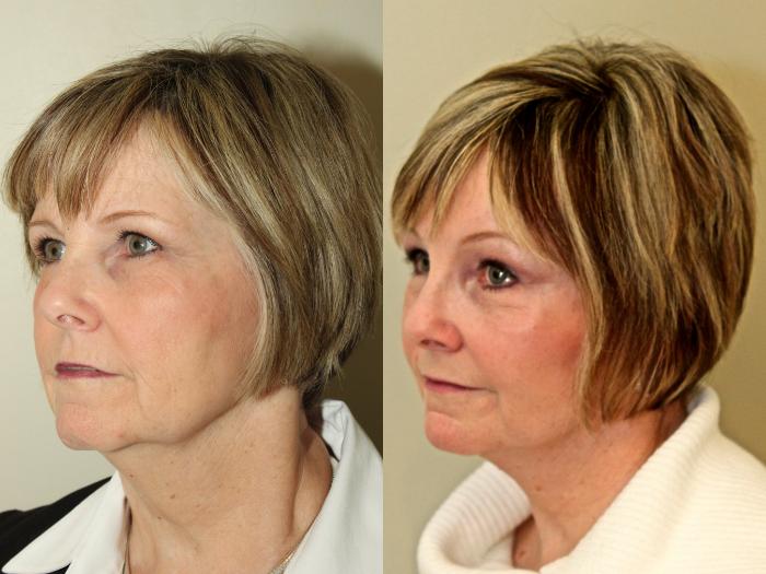 Before & After Facelift & Neck Lift Case 77 View #3 View in Mississauga & Toronto, ON