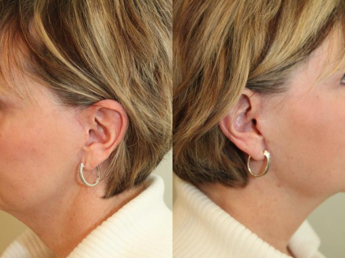 Before & After Facelift & Neck Lift Case 77 View #5 View in Mississauga & Toronto, ON