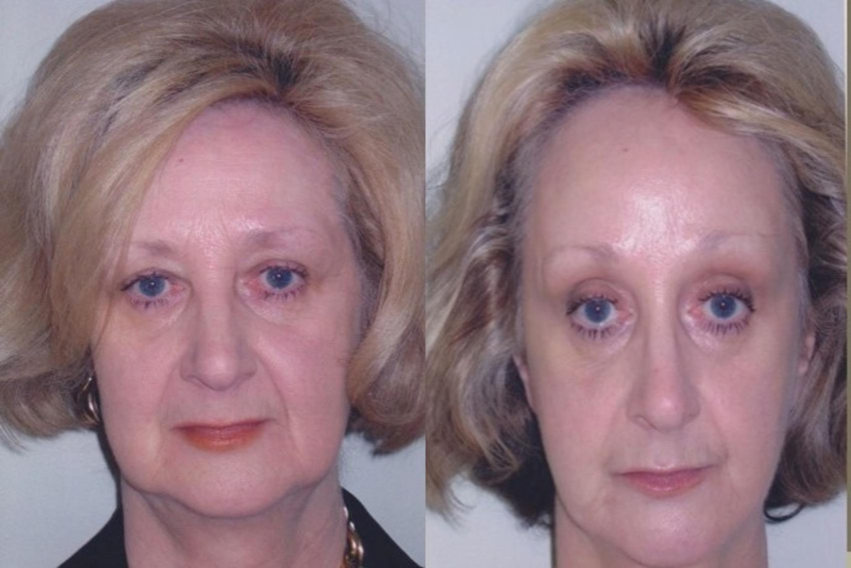 Before & After Facelift & Neck Lift Case 83 View #1 View in Mississauga & Toronto, ON