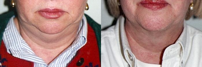Before & After Facial Liposuction Case 44 View #1 View in Mississauga & Toronto, ON