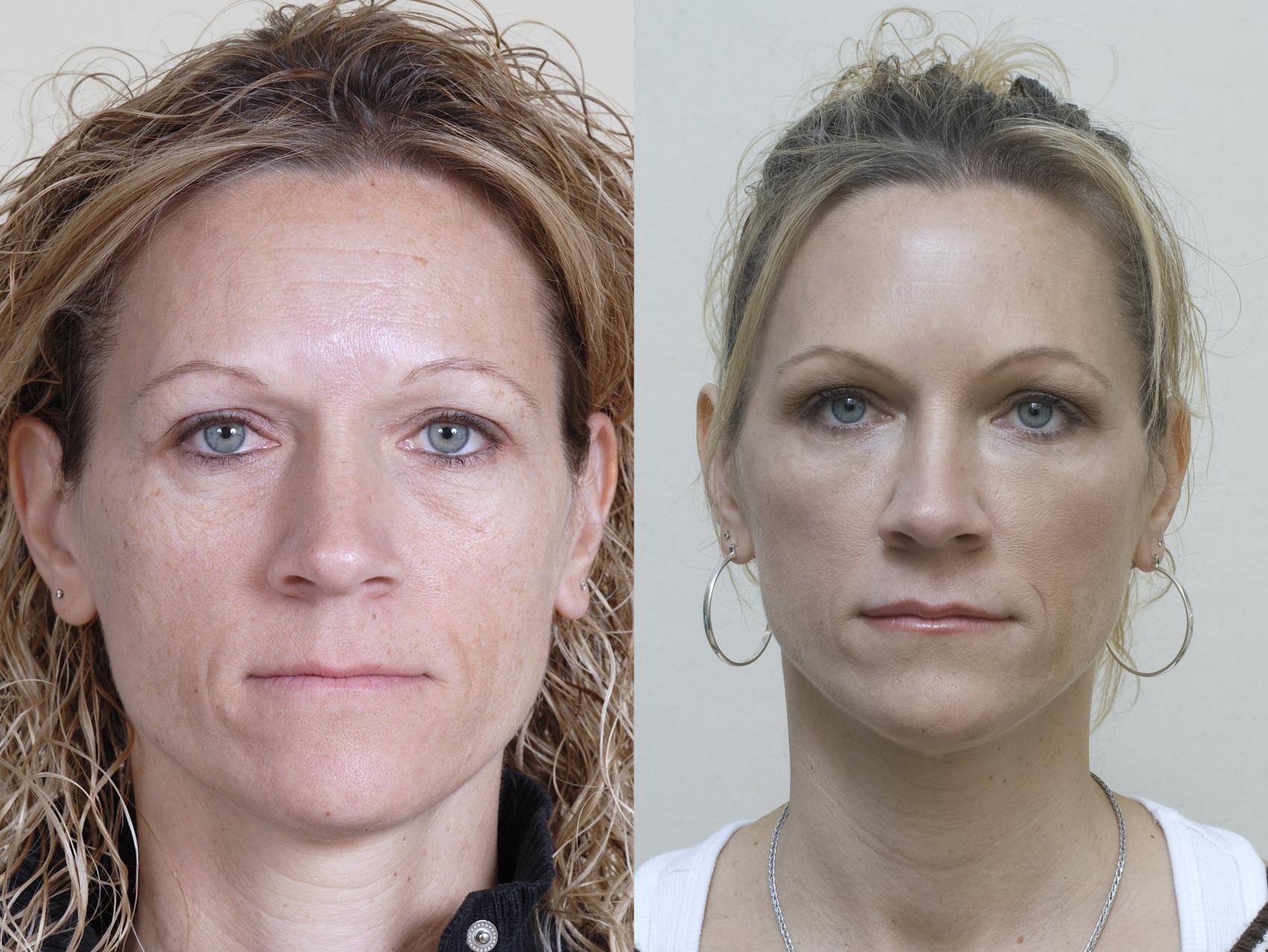 Before & After Injectable Fillers Case 41 View #1 View in Mississauga & Toronto, ON