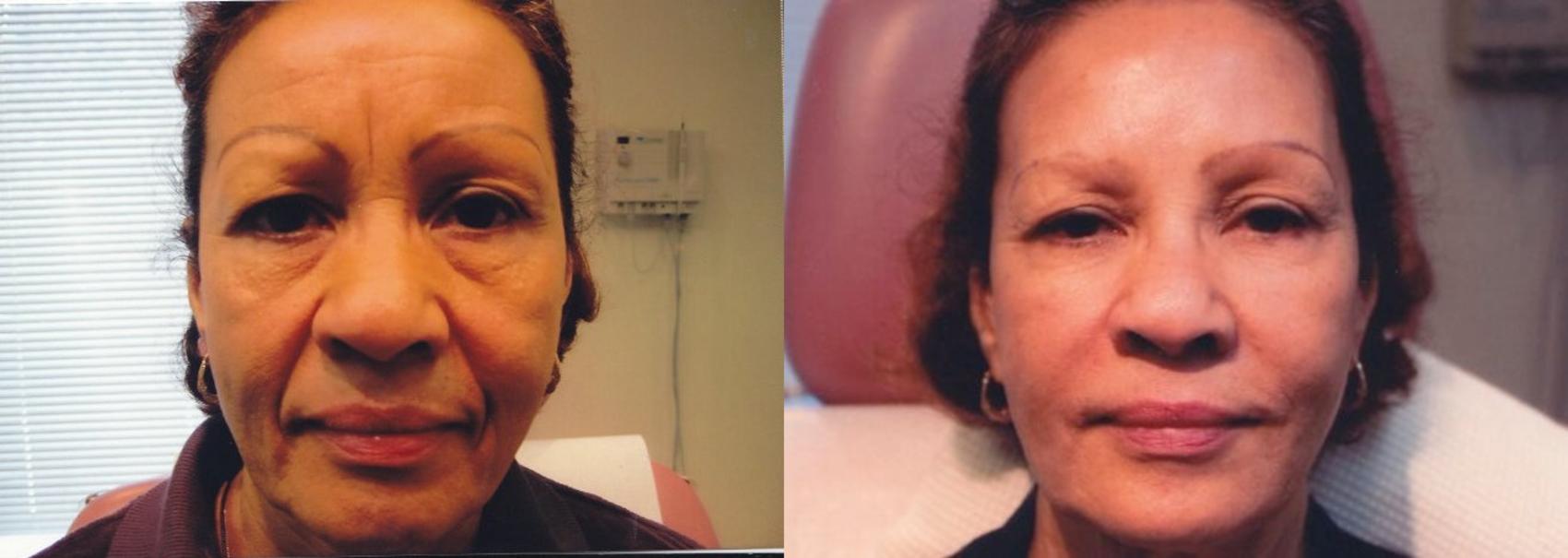 Before & After Prescription Wrinkle Injections Case 85 View #1 View in Mississauga & Toronto, ON