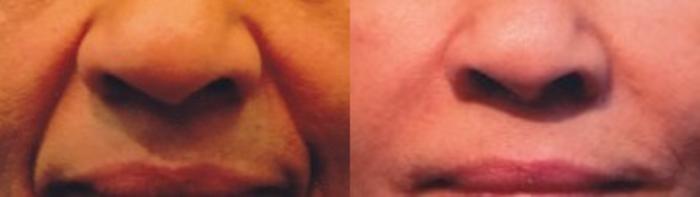 Before & After Prescription Wrinkle Injections Case 85 View #2 View in Mississauga & Toronto, ON