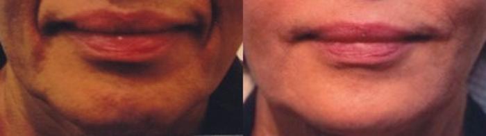 Before & After Nonsurgical Facelift Case 85 View #3 View in Mississauga & Toronto, ON