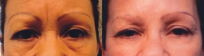Before & After Prescription Wrinkle Injections Case 85 View #4 View in Mississauga & Toronto, ON