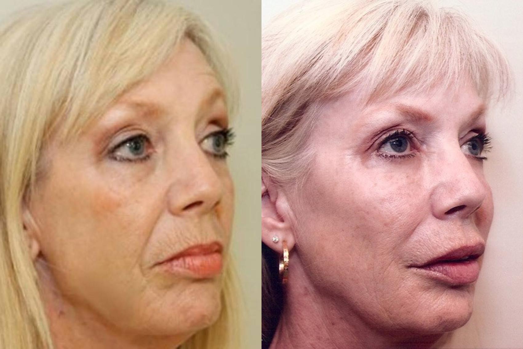 Before & After Injectable Fillers Case 9 View #1 View in Mississauga & Toronto, ON