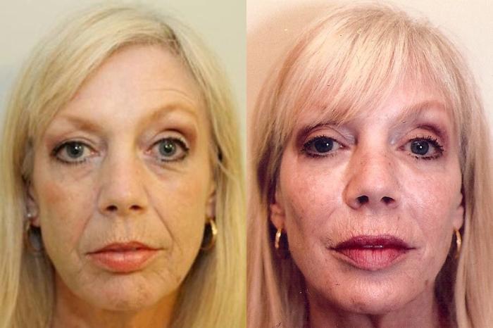 Before & After Nonsurgical Facelift Case 9 View #2 View in Mississauga & Toronto, ON