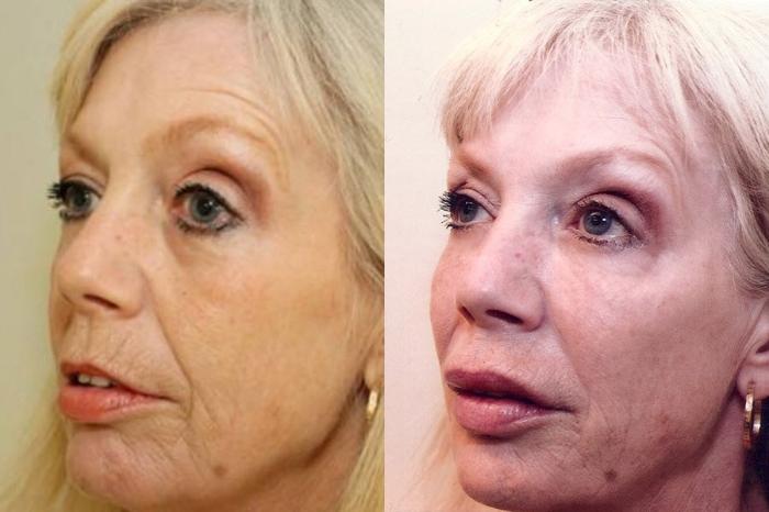 Before & After Nonsurgical Facelift Case 9 View #3 View in Mississauga & Toronto, ON