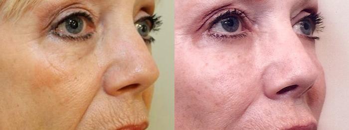 Before & After Prescription Wrinkle Injections Case 9 View #4 View in Mississauga & Toronto, ON