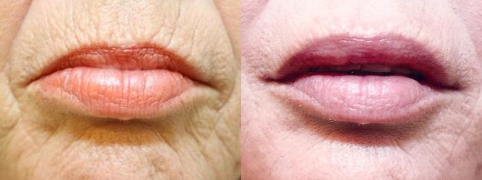 Before & After Prescription Wrinkle Injections Case 9 View #6 View in Mississauga & Toronto, ON