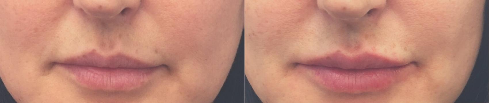 Before & After Injectable Fillers Case 105 Front View in Mississauga & Toronto, ON