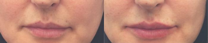 Before & After Lip Augmentation Case 105 Front View in Mississauga & Toronto, ON