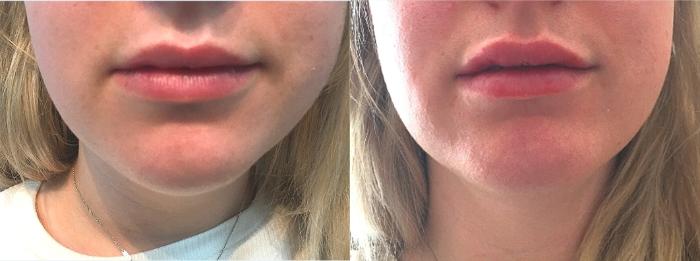 Before & After Lip Augmentation Case 113 Front View in Mississauga & Toronto, ON
