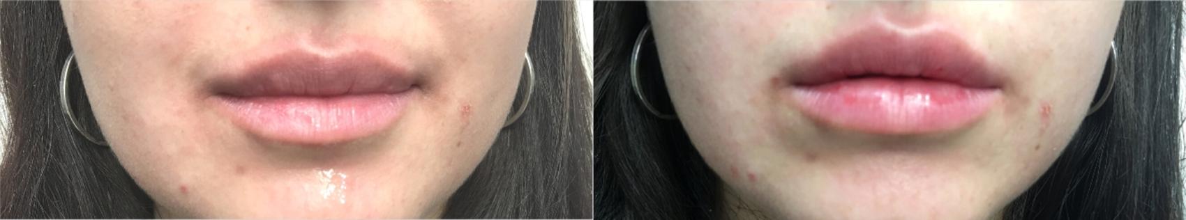 Before & After Injectable Fillers Case 124 Front View in Mississauga & Toronto, ON