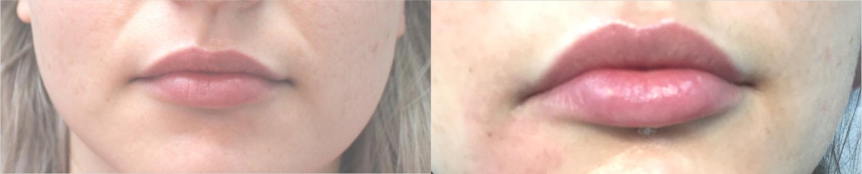 Before & After Lip Augmentation Case 125 Front View in Mississauga & Toronto, ON
