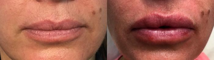 Before & After Injectable Fillers Case 126 Front View in Mississauga & Toronto, ON