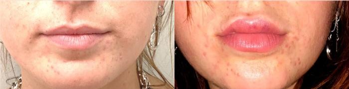 Before & After Lip Augmentation Case 127 Front View in Mississauga & Toronto, ON