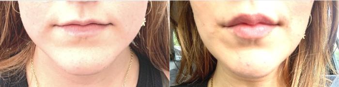 Before & After Lip Augmentation Case 128 Front View in Mississauga & Toronto, ON