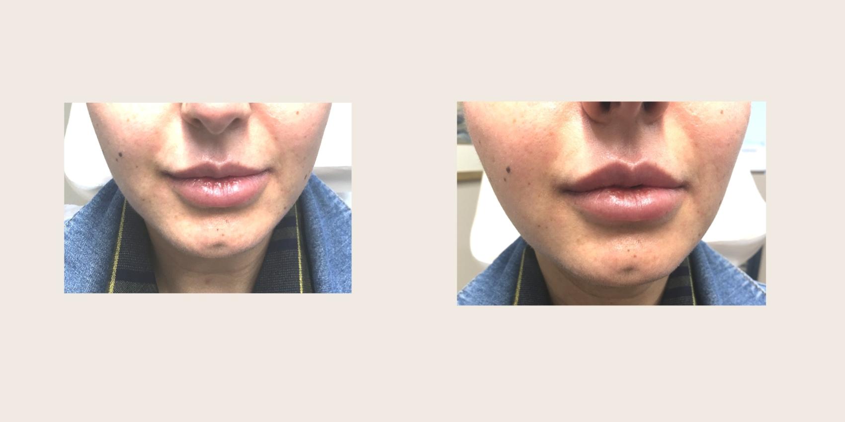 Before & After Lip Augmentation Case 130 Front View in Mississauga & Toronto, ON