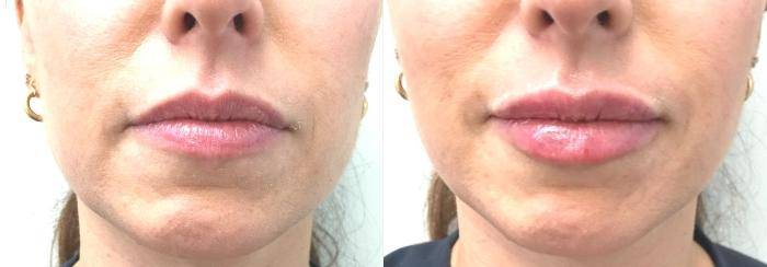 Before & After Lip Augmentation Case 132 Front View in Mississauga & Toronto, ON