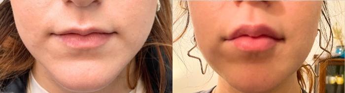 Before & After Lip Augmentation Case 135 Front View in Mississauga & Toronto, ON