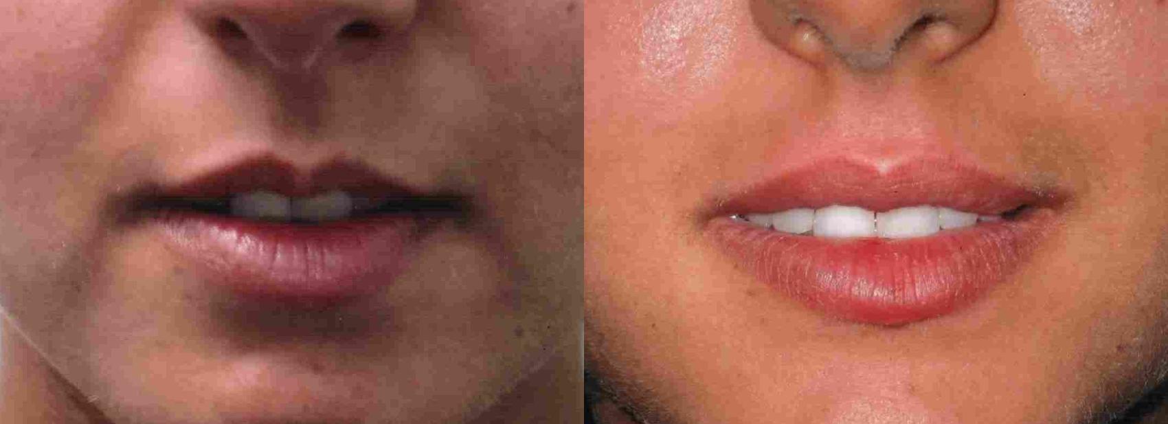 Before & After Lip Augmentation Case 43 View #1 View in Mississauga & Toronto, ON