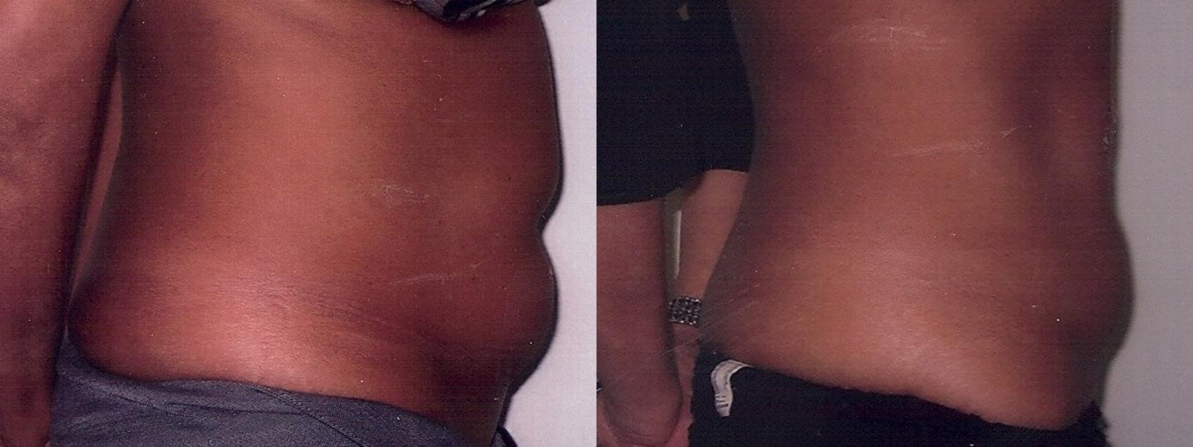 Before & After Liposuction Case 16 View #2 View in Mississauga & Toronto, ON