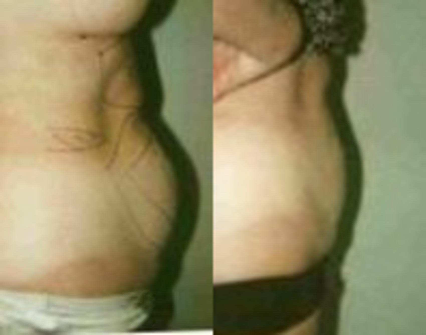 Before & After Liposuction Case 34 View #1 View in Mississauga & Toronto, ON