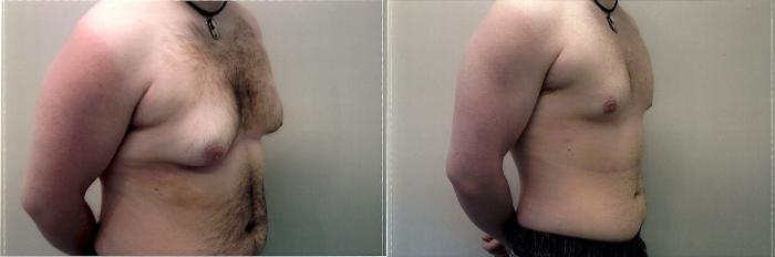 Before & After Liposuction Case 68 View #2 View in Mississauga & Toronto, ON