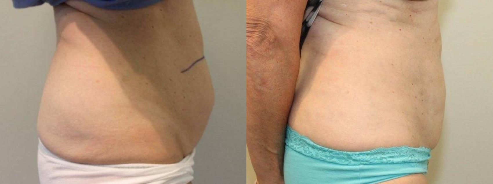 Before & After Liposuction Case 73 View #1 View in Mississauga & Toronto, ON