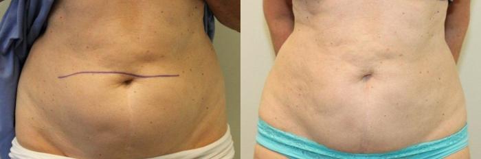 Before & After Liposuction Case 73 View #2 View in Mississauga & Toronto, ON