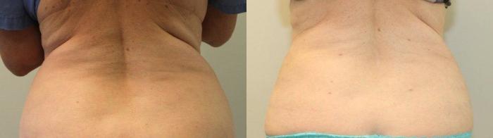 Before & After Liposuction Case 73 View #3 View in Mississauga & Toronto, ON
