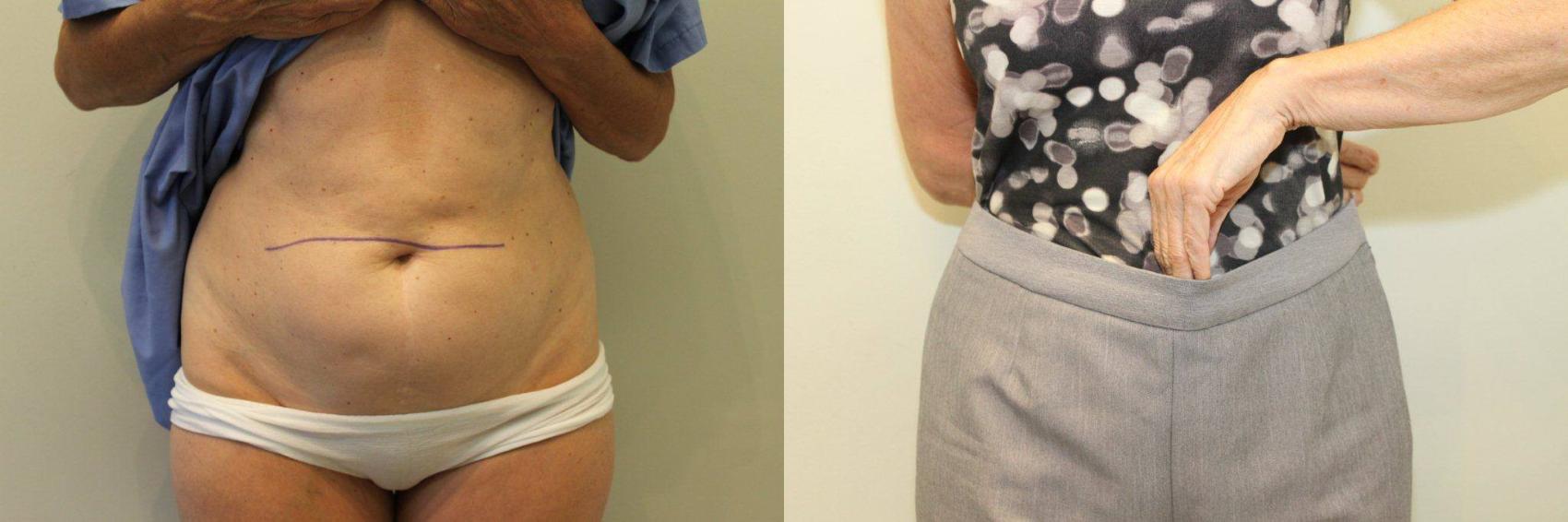 Before & After Liposuction Case 73 View #4 View in Mississauga & Toronto, ON