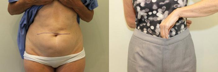 Before & After Liposuction Case 73 View #4 View in Mississauga & Toronto, ON