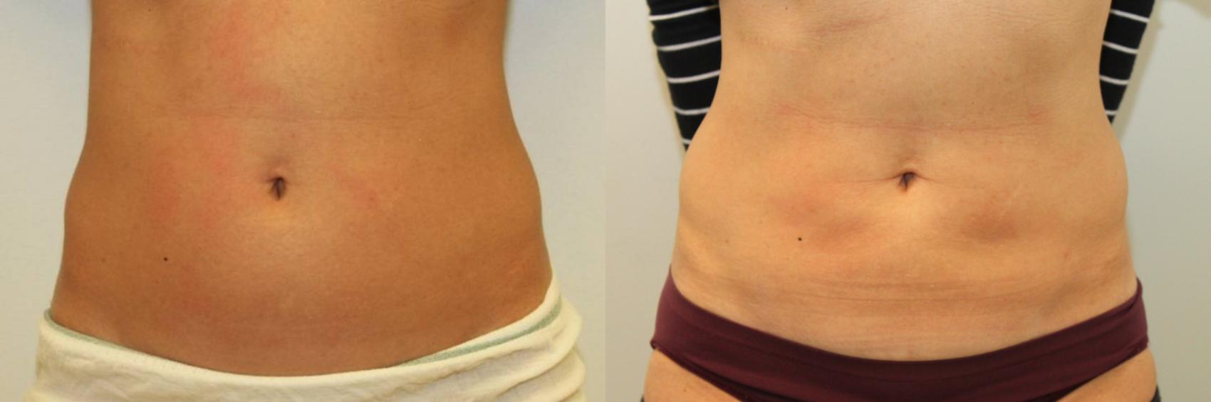 Before & After Liposuction Case 78 View #1 View in Mississauga & Toronto, ON