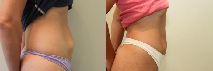 Before & After Liposuction Case 79 View #1 View in Mississauga & Toronto, ON