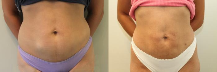 Before & After Liposuction Case 79 View #2 View in Mississauga & Toronto, ON
