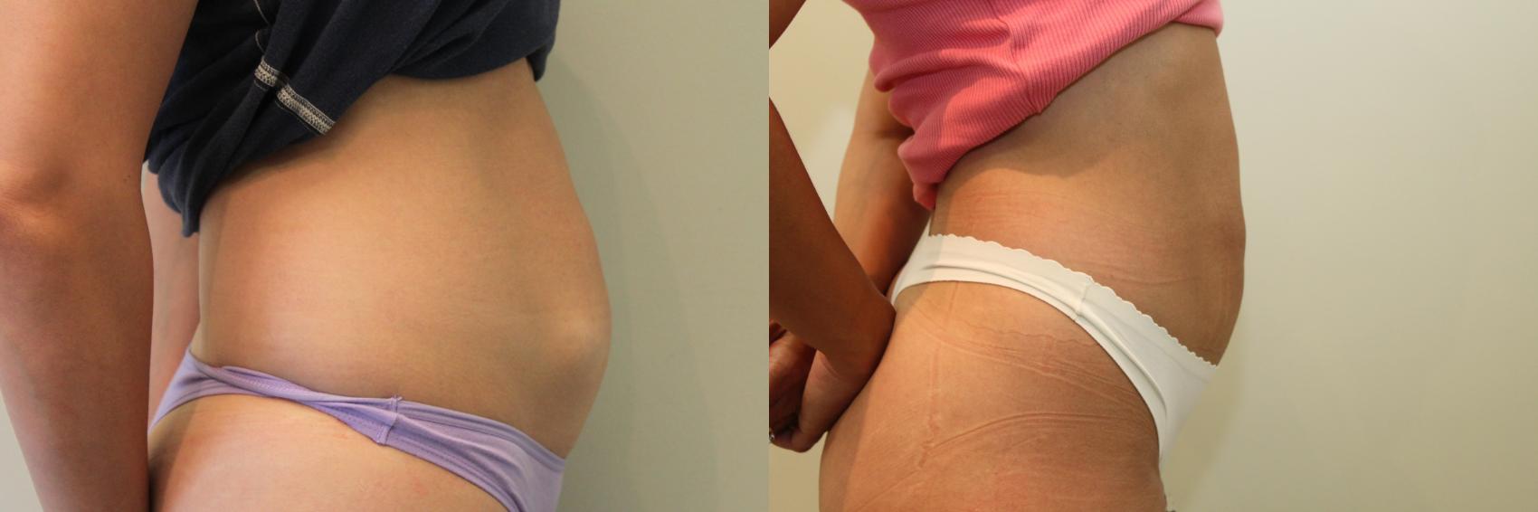 Before & After Liposuction Case 79 View #3 View in Mississauga & Toronto, ON