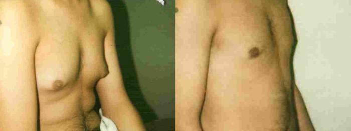 Before & After Male Breast Reduction Case 20 View #2 View in Mississauga & Toronto, ON