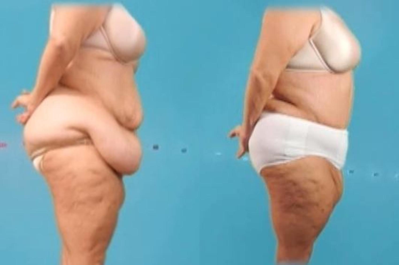 Before & After Massive Weight Loss Case 33 View #1 View in Mississauga & Toronto, ON