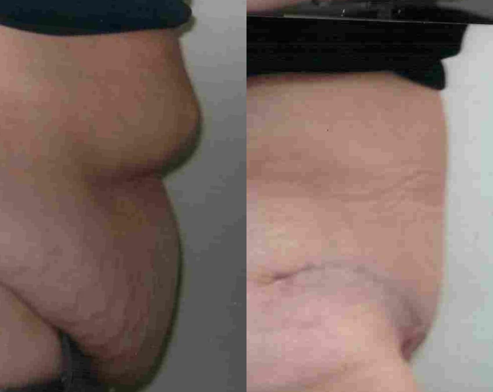 Before & After Massive Weight Loss Case 49 View #1 View in Mississauga & Toronto, ON