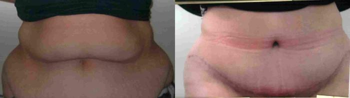 Before & After Massive Weight Loss Case 49 View #2 View in Mississauga & Toronto, ON