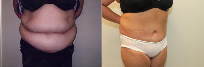 Before & After Liposuction Case 53 View #1 View in Mississauga & Toronto, ON