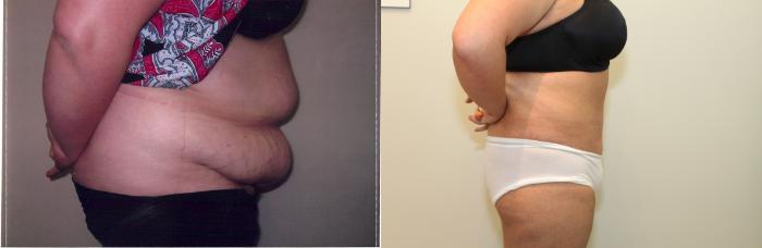 Before & After Liposuction Case 53 View #2 View in Mississauga & Toronto, ON