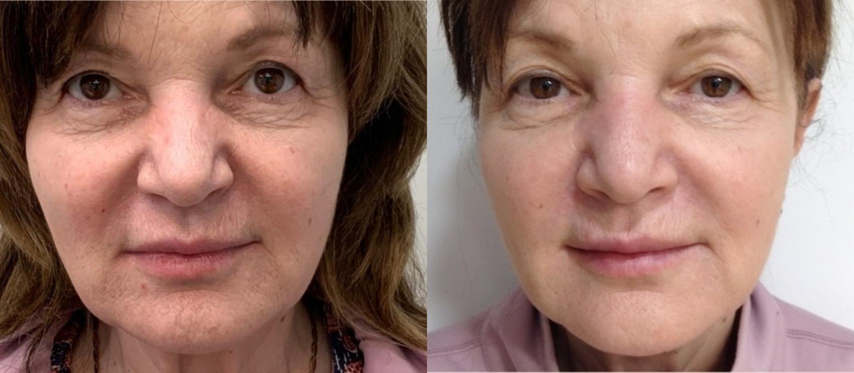 Before & After Microneedling Case 136 Front View in Mississauga & Toronto, ON