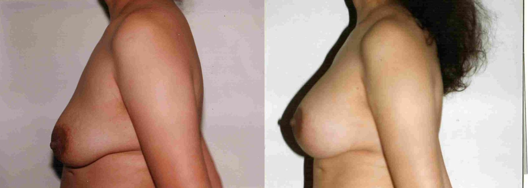 Before & After Breast Lift Case 45 View #1 View in Mississauga & Toronto, ON