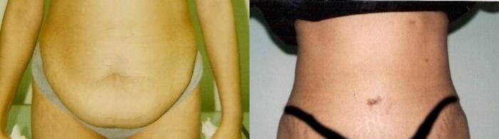 Before & After Mommy Makeover Case 45 View #3 View in Mississauga & Toronto, ON