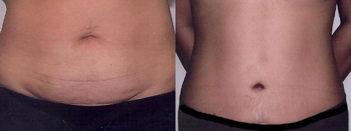 Before & After Mommy Makeover Case 5 View #3 View in Mississauga & Toronto, ON