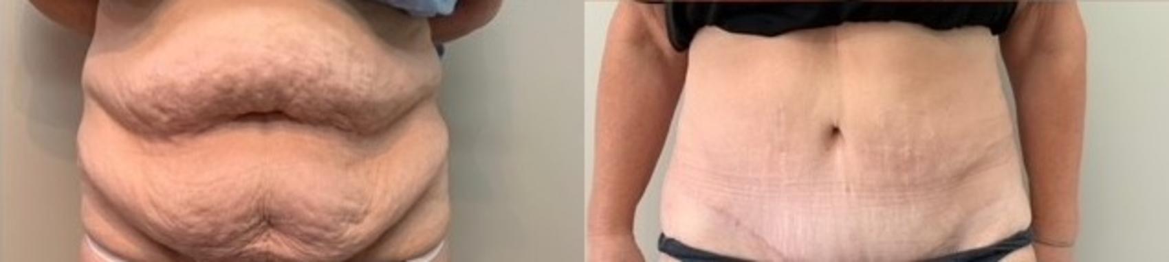 Before & After Tummy Tuck Case 100 View #1 View in Mississauga & Toronto, ON