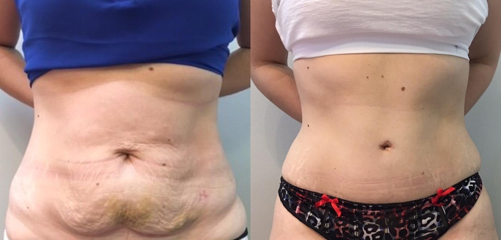 Before & After Tummy Tuck Case 102 View #1 View in Mississauga & Toronto, ON